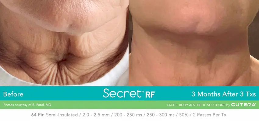 FACE Labs Secret RF B&A