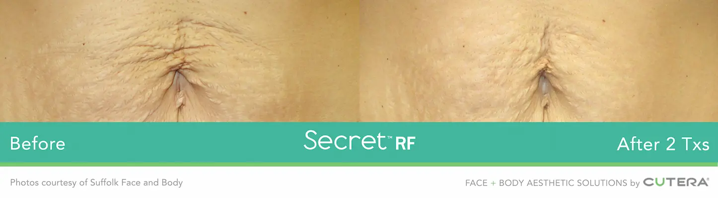 SecretRF-Suffolk Face Body-P1_highres-3